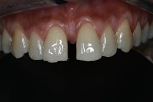 Zahnfarbene Kunststofffüllungen - Situation vorher