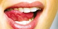 Hauptursache für Parodontitis ist der bakterielle Zahnbelag