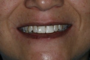 Zahnfarbene Füllungen - Nach legen der Füllung