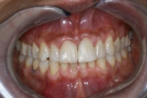Zahnfarbene Kunststofffüllungen